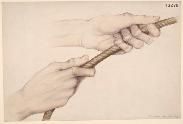 Deformity of the hands, simulating rheumatoid arthritis (with rope)