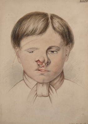 Head of a boy with a cleft palate and hare-lip