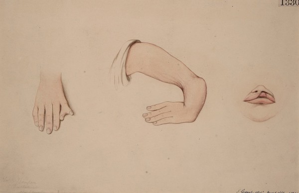 Child with hare-lip, congenital absence of the left radius and bifid right thumb