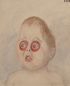 Child with extreme congenital proptosis and microcephalus