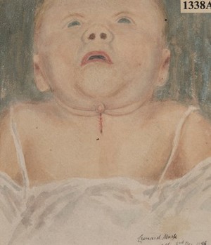 view Child with congenital fistula