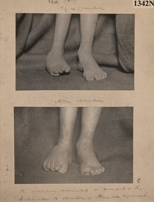 view Lower extremities of a boy with talipes varus and pes cavus
