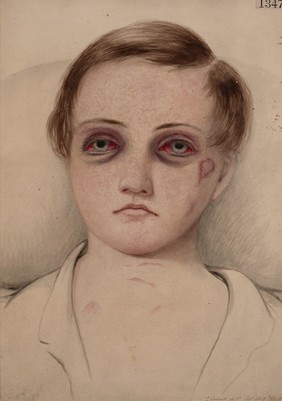 Boy with punctiform ecchymoses on his face