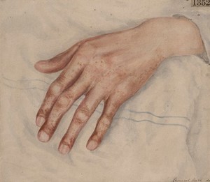 view Right hand of man with pigmentation of the skin and clubbing of the fingers