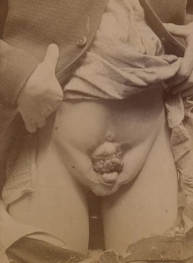 Groin of a patient with ectopia vesicae