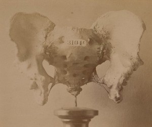 view Pelvis of a man who had extroversion of the bladder
