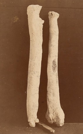 Right ulna and radius affected with pulmonary osteo-arthropathy (posterior view)