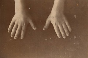 view Hands of a girl with achondroplasia