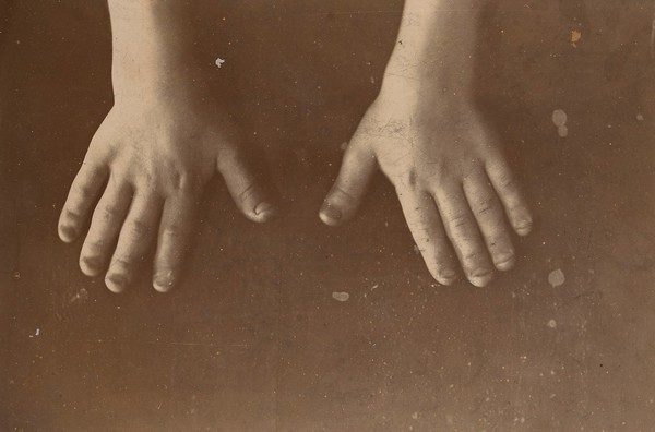 Hands of a girl with achondroplasia