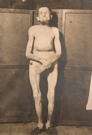 view Man with osteitis deformans