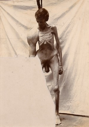 view Cadaver of a man with osteitis deformans