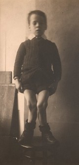 Great deformity of the legs due to rickets