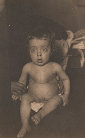 Child with rachitic deformity of the thorax