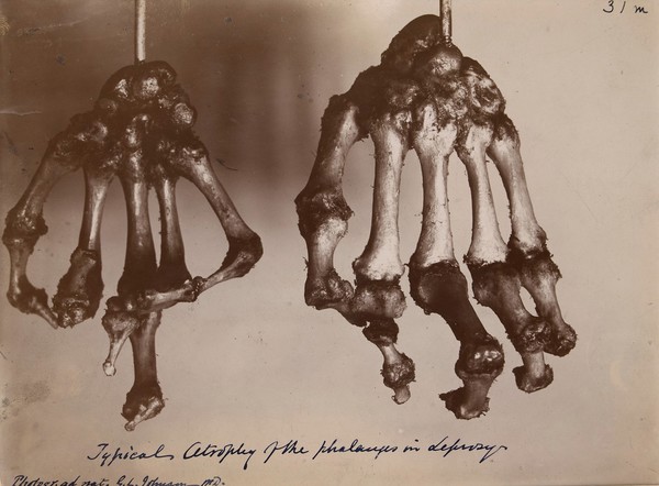 Bones of the hands of two lepers