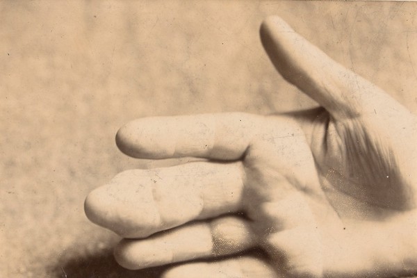 Hand of a woman with enchondromata of the middle finger