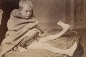 view Boy with deformity of the left leg