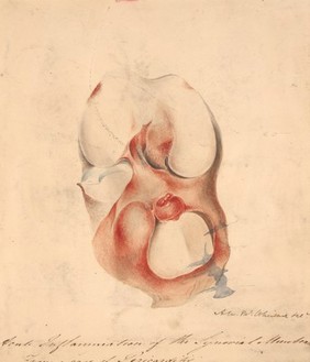 Acute inflammation of the synovial membrane of the knee joint