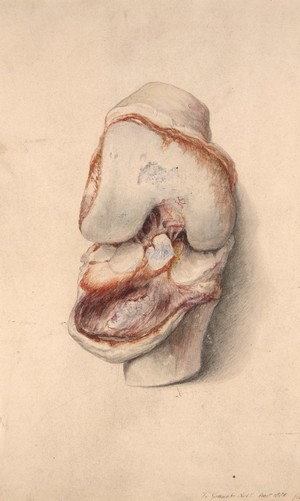 view Knee joint of a haemophiliac