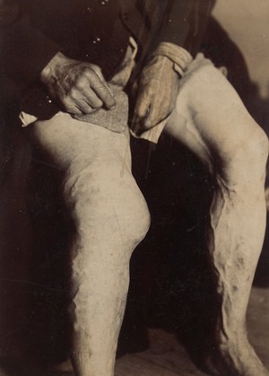 view Deformity of the knee due to Charcot's disease