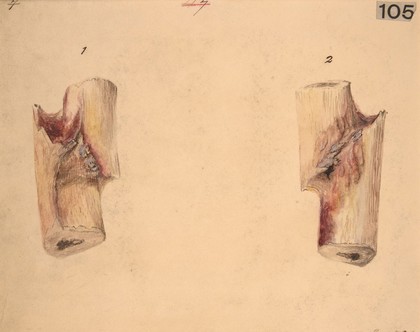 Fracture of a tibia, five weeks after the accident (Figs 1-2)