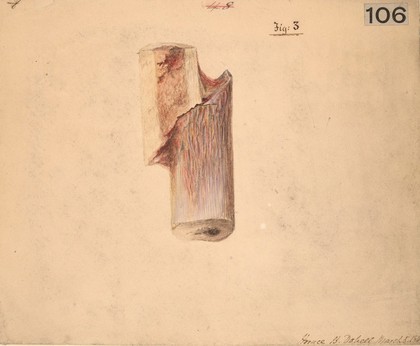 Fracture of a tibia, five weeks after the accident (Fig 3)