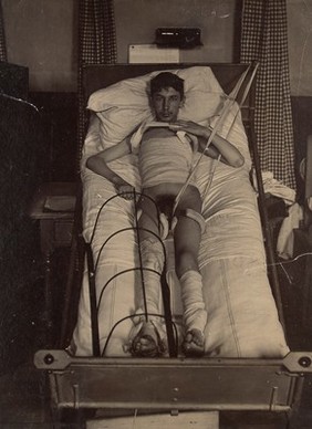 Youth suffering from lateral spine curvature, corrected with a double Thomas' splint