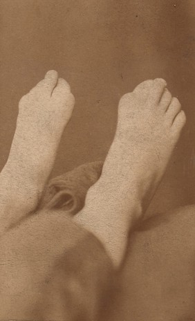 Feet of a patient affected with myositis ossificans