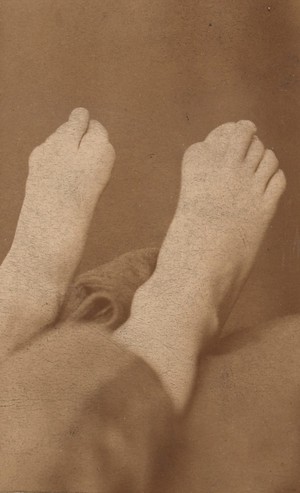 view Feet of a patient affected with myositis ossificans