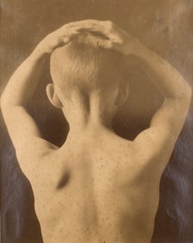 Neck and shoulders of a boy with wasting of the left trapezius