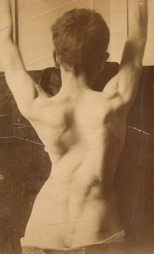 view Back of a youth showing the falling in of the chest after empyema