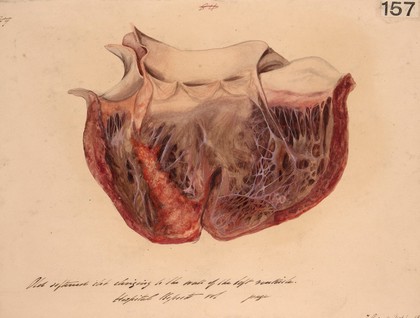 Heart with an old softened clot clinging to the wall of the left ventricle