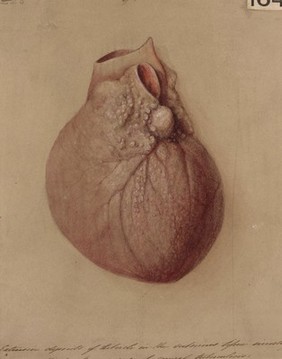 Miliary tubercles in the sub-serous tissue investing the heart