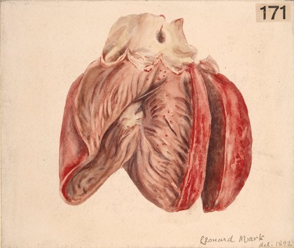 Ulcers on the endocardial surface of the right ventricle