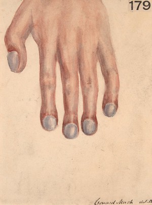 view Left hand of a boy with congenital malformation of the heart