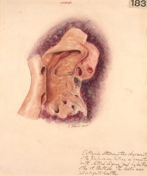 view Extensive atheroma of the pulmonary artery