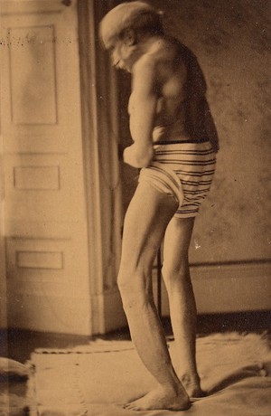 view Man with osteitis deformans, standing, side view