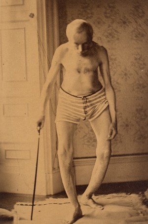 view Man with osteitis deformans, front view, walking