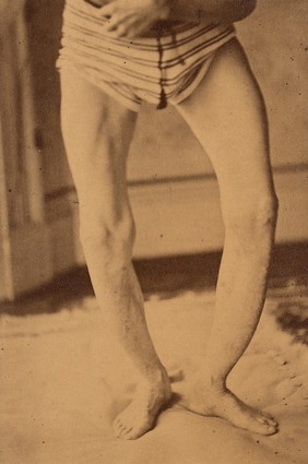 Legs of a man with osteitis deformans