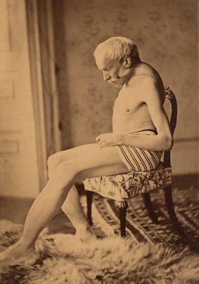 Man with osteitis deformans, side view, seated