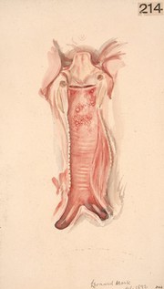 Interior of the trachea of a woman who died from glanders