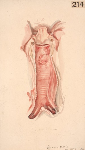 view Interior of the trachea of a woman who died from glanders