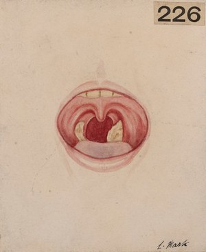 view Tonsils, each with a grey patch of diphtheric 'membrane'