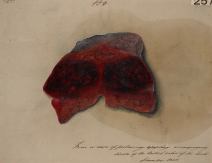 Pulmonary apoplexy accompanying disease of the mitral valve