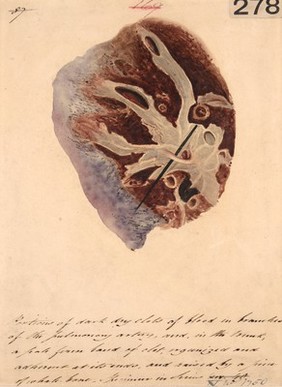 Pulmonary clot