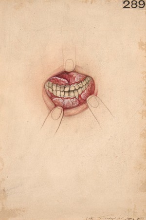 view Hypertrophy of the gums after an attack of diphtheria