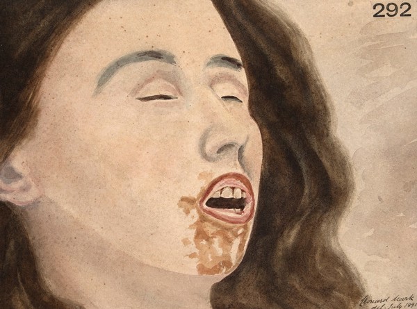 Face of a woman who died from carbolic acid poisoning