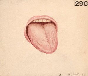 view Hemiatrophy and hemiplegia of the left side of the tongue