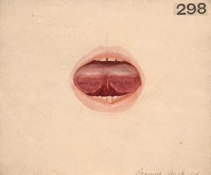 Tongue of a boy in a state of acute glossitis