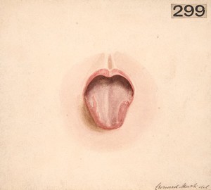 view Tongue of a child with Bright's disease