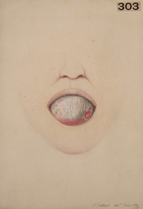 Tongue with diphtheritic membrane